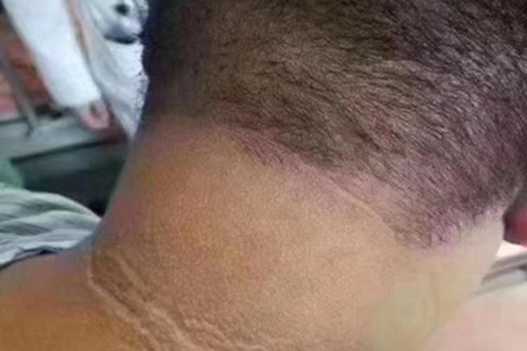 假性黑棘皮病后颈皮肤很黑图