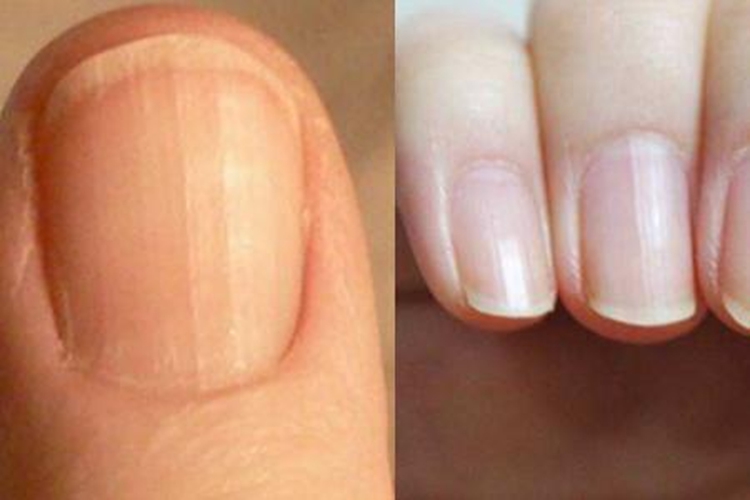 指甲上有竖纹图