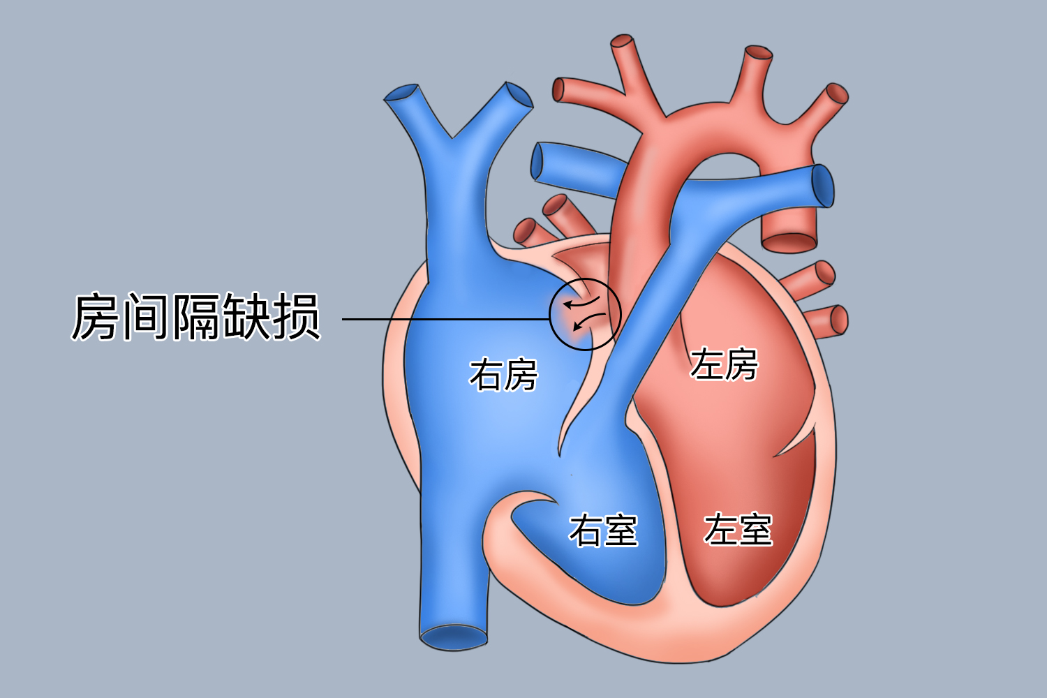 房间隔缺损示意图