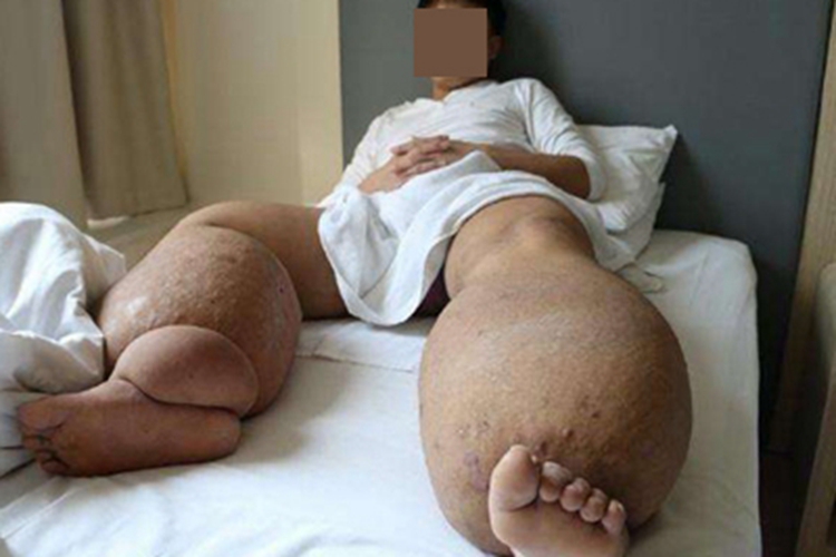 淋巴丝虫病小腿症状图
