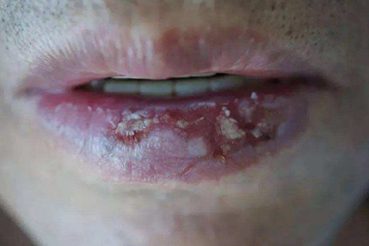 浆细胞性唇炎糜烂图 浆细胞性唇炎糜烂图