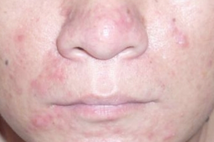 丘疹脓疱型酒糟鼻鼻周发红图
