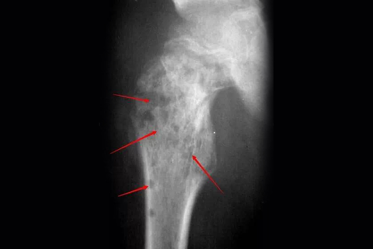 儿童骨髓炎图 儿童骨髓炎图