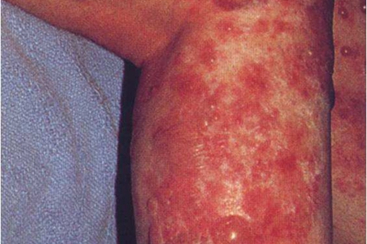 落叶型天疱疮小腿红斑图 落叶型天疱疮小腿红斑图