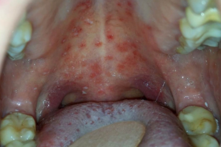 咽喉疱疹咽喉疱疹图 咽喉疱疹咽喉疱疹图