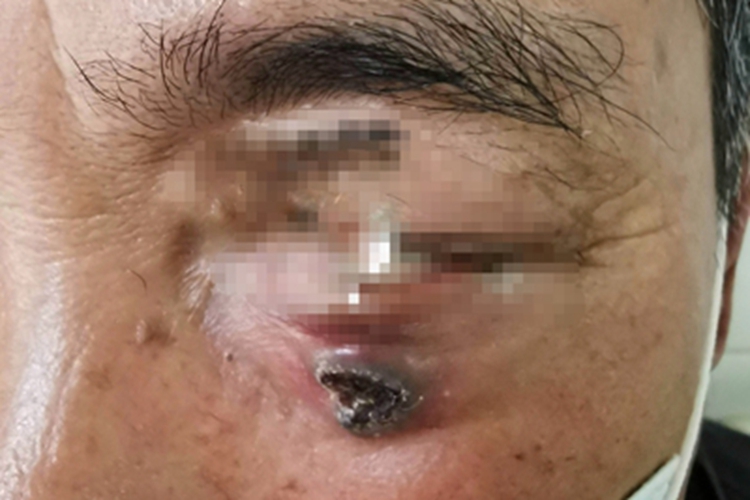 结节型基底细胞瘤下眼皮有黑斑图 结节型基底细胞瘤下眼皮有黑斑图