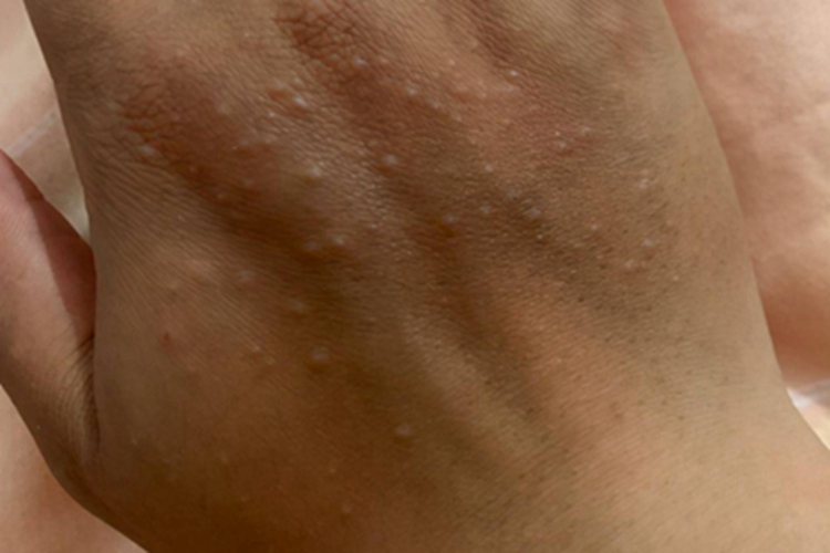 黏液水肿性苔藓手背长丘疹图