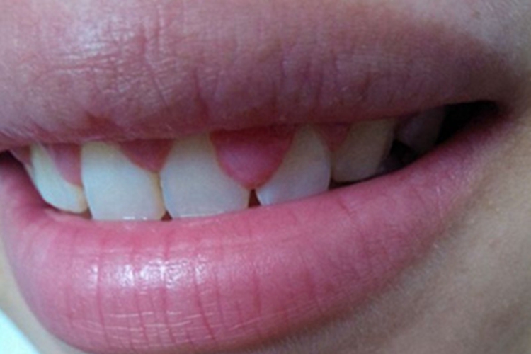 牙龈瘤上牙龈肿块图