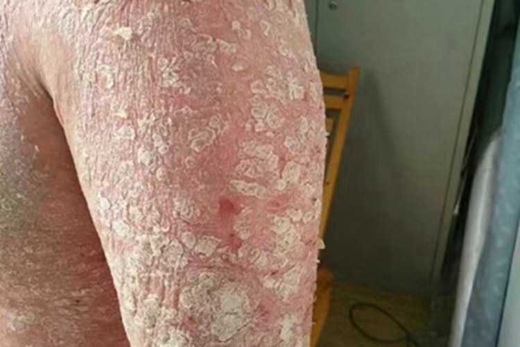 银屑病胳膊脱皮图