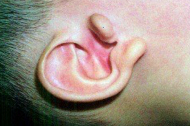 副耳耳前症状图