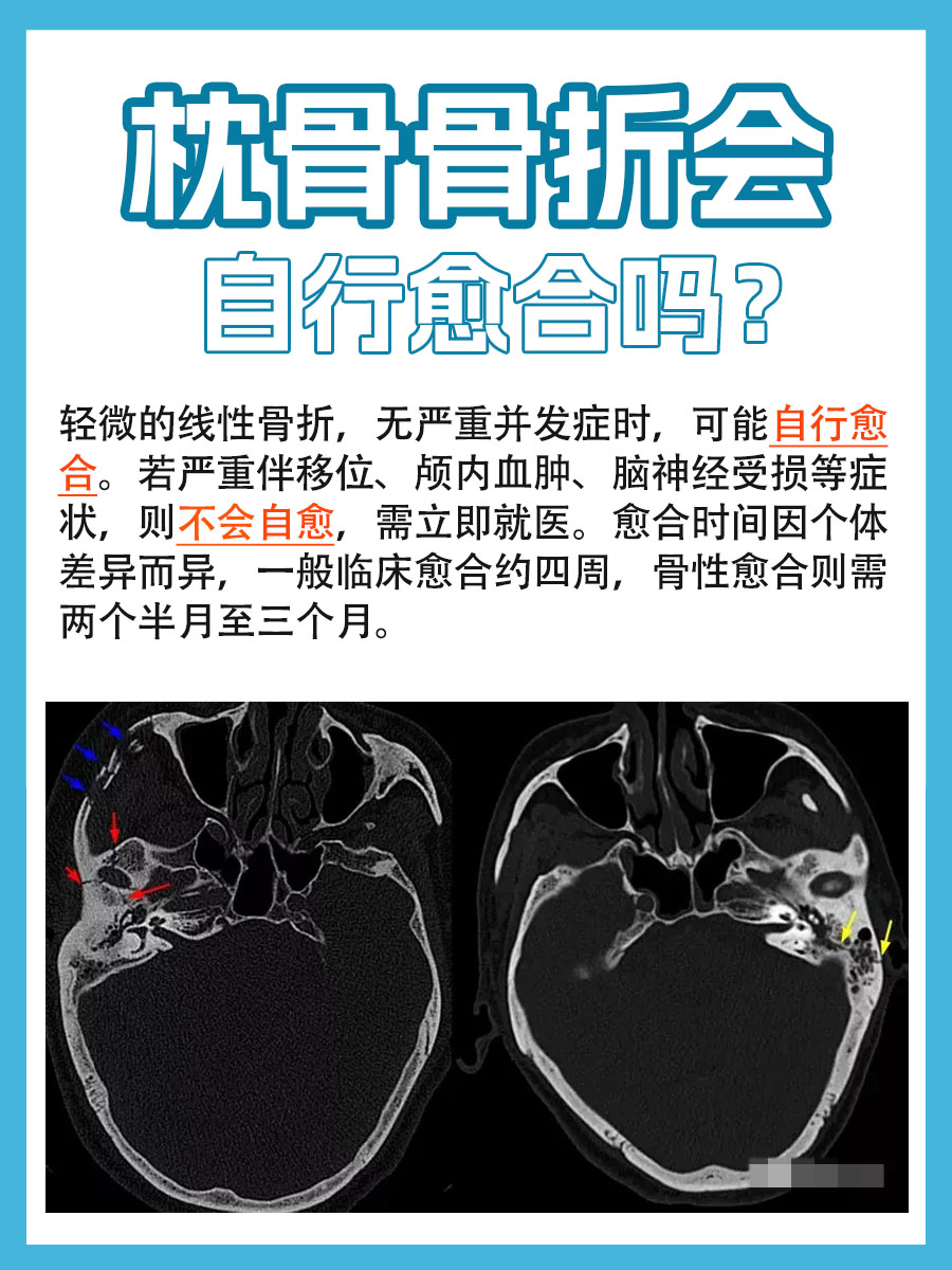 带你了解：枕骨骨折会自行愈合吗？