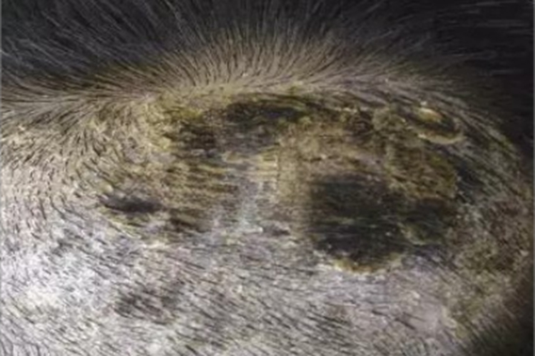 黑点癣头皮有黑色硬皮图 黑点癣头皮有黑色硬皮图