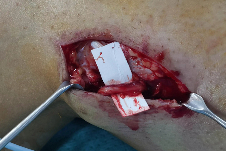 腓总神经松解术切口图