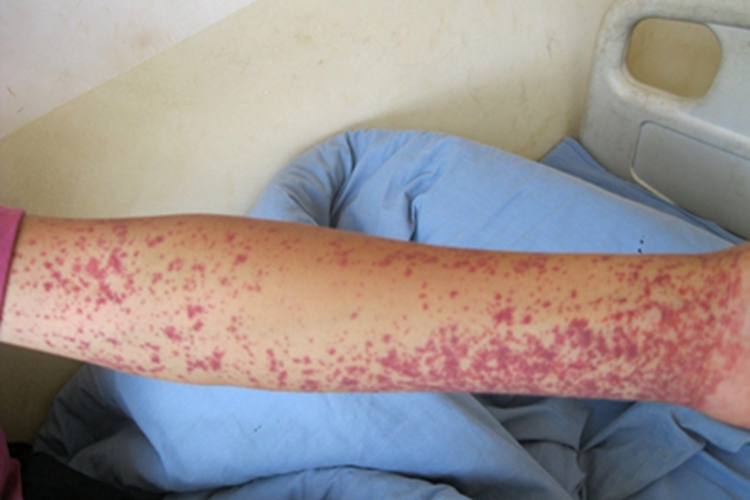 冷球蛋白血症性紫癜胳膊紫斑图