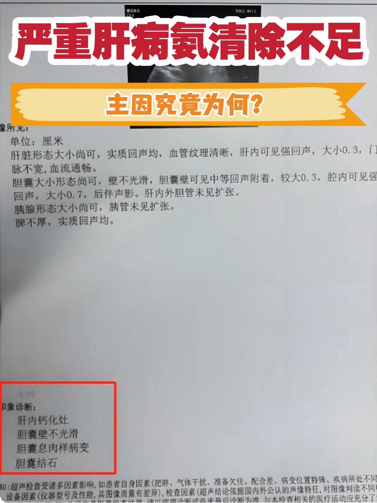严重肝病氨清除不足，主因究竟为何？