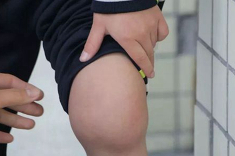 血友病长大包图