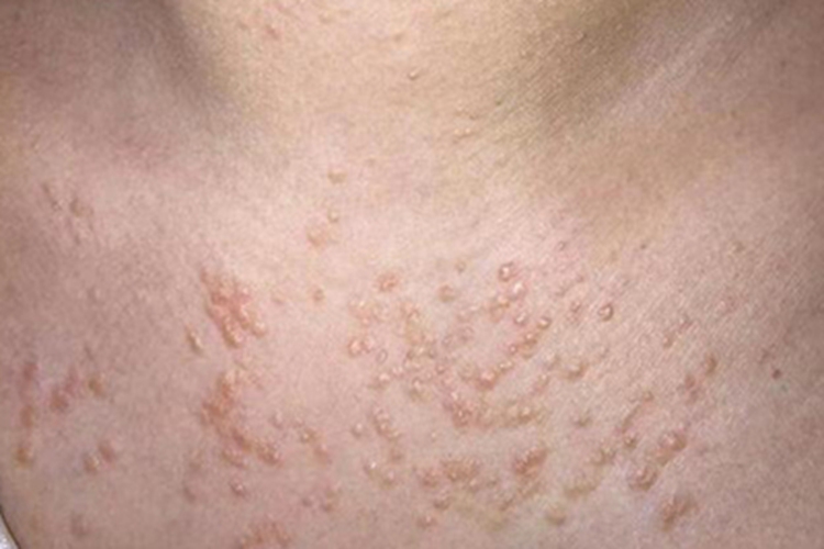 皮脂腺异位症疙瘩图