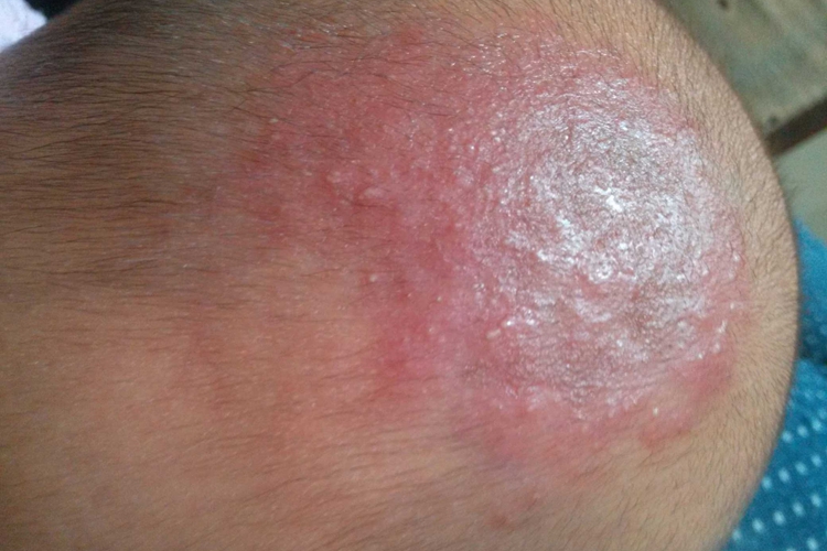 急性湿疹头皮症状图