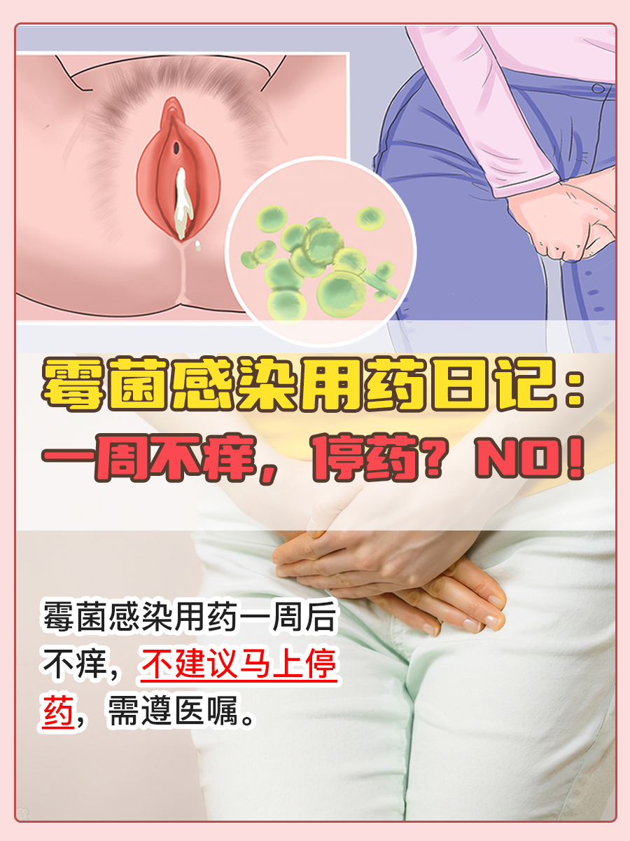 霉菌感染用药日记：一周不痒，停药？NO！