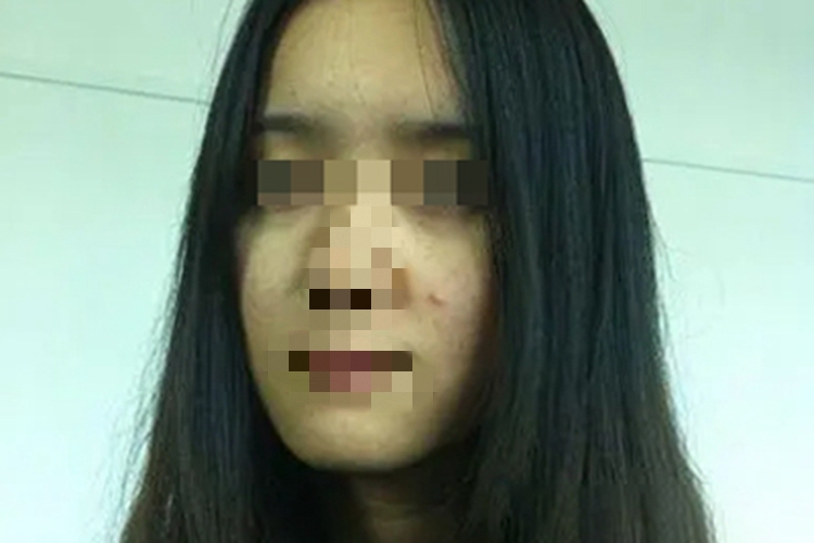 胡萝卜素血症面部症状图 胡萝卜素血症面部症状图