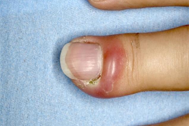 急性甲沟炎手指红肿图