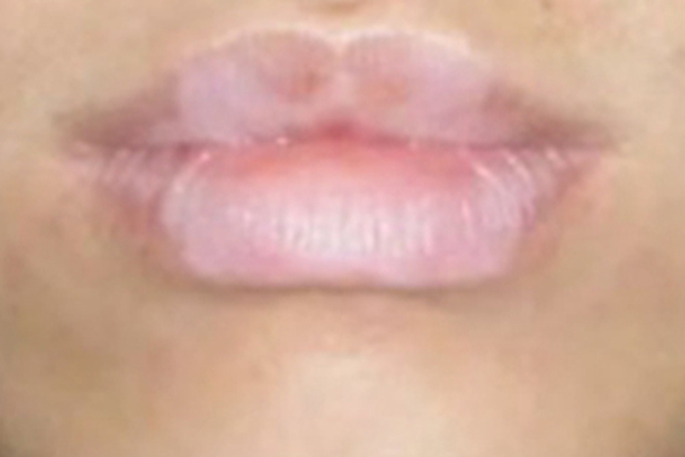 黏膜型白癜风嘴唇症状图
