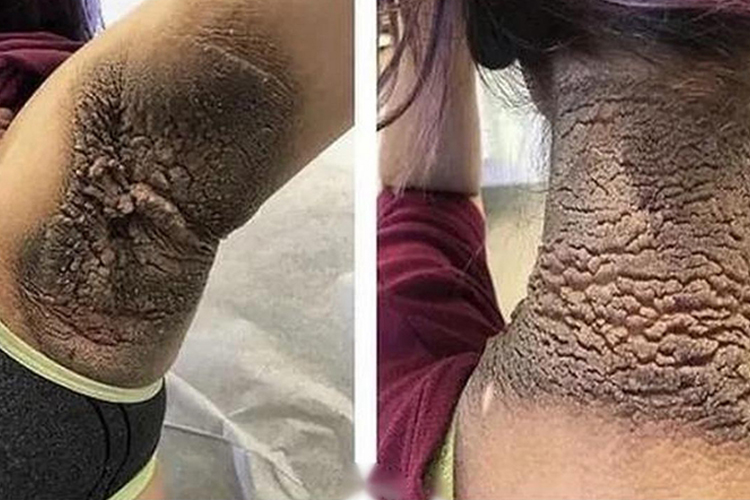 恶性黑棘皮病图