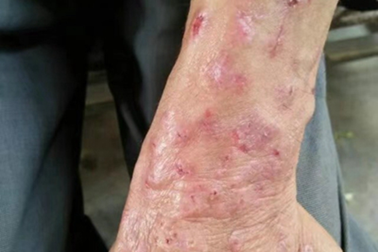 急性湿疹胳膊糜烂图