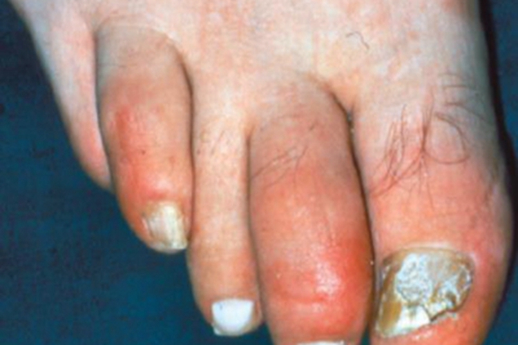 银屑病关节炎脚趾甲粗糙图 银屑病关节炎脚趾甲粗糙图