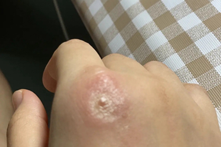 蠓叮咬手背红斑脱屑图