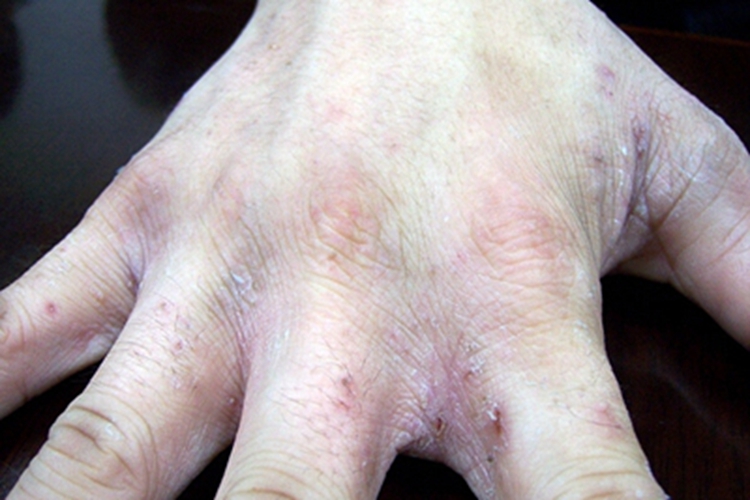 结痂性疥疮手指缝结痂图