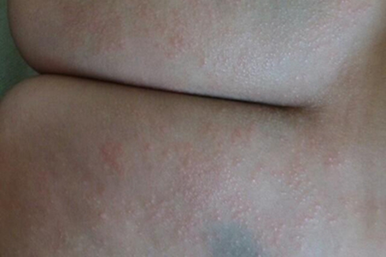 尿布皮炎症状图