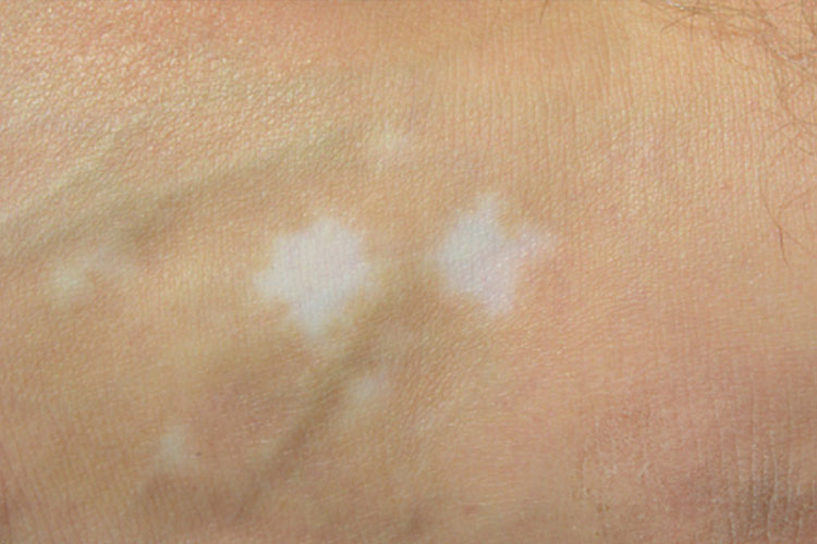 不规则形色素减退斑图