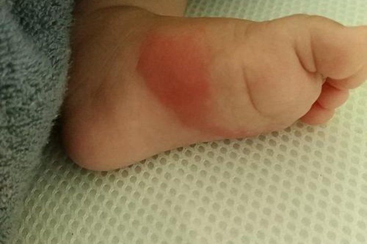 小孩脚底外伤红印图