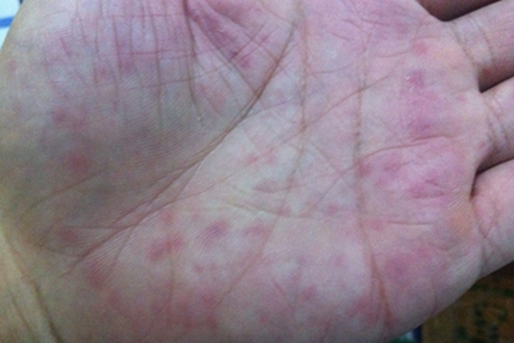 肝掌手掌有点状红斑图