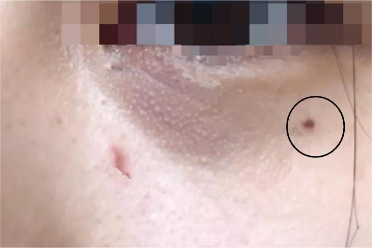 基底细胞痣综合征长痣图