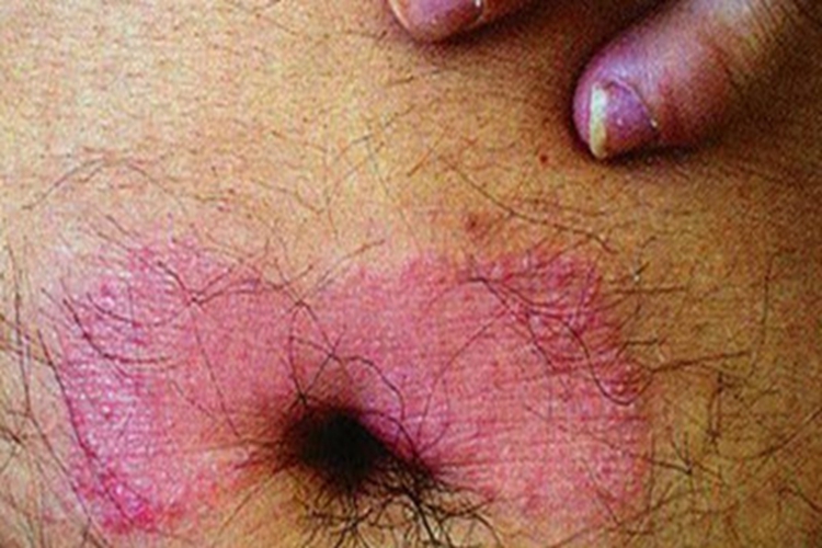 扁平苔藓肚脐症状图