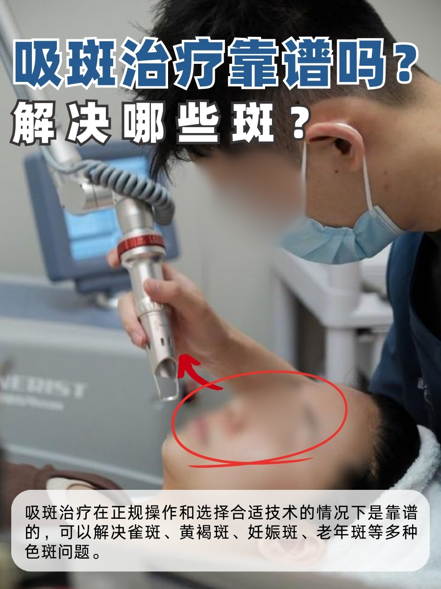 吸斑治疗靠谱吗?解决哪些斑?