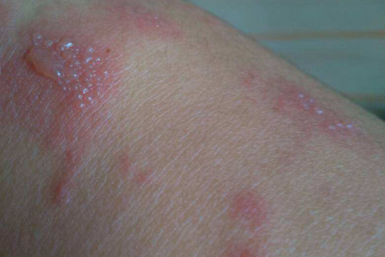 吃金枪鱼过敏湿疹图