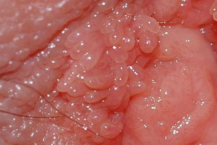 皮损呈绒毛状图