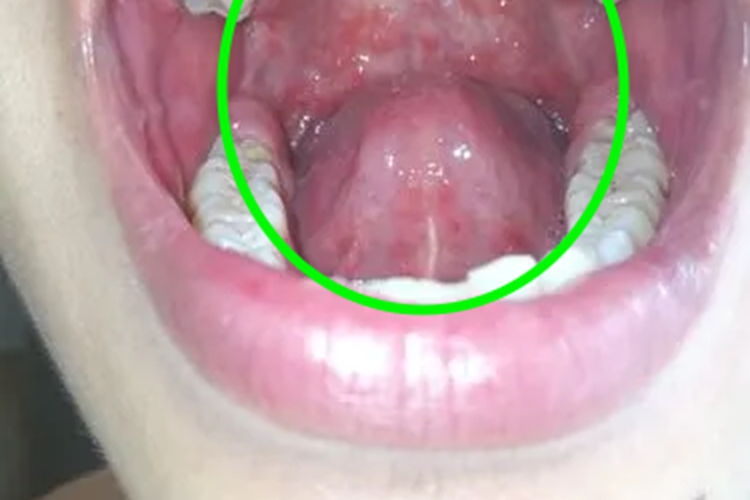 口腔梅毒咽峡红点图 口腔梅毒咽峡红点图