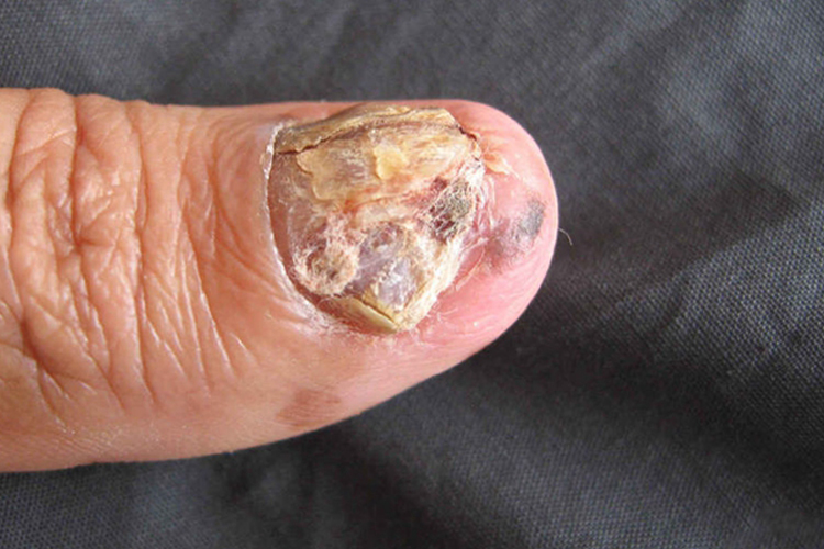 指甲里的黑色素瘤图 指甲里的黑色素瘤图