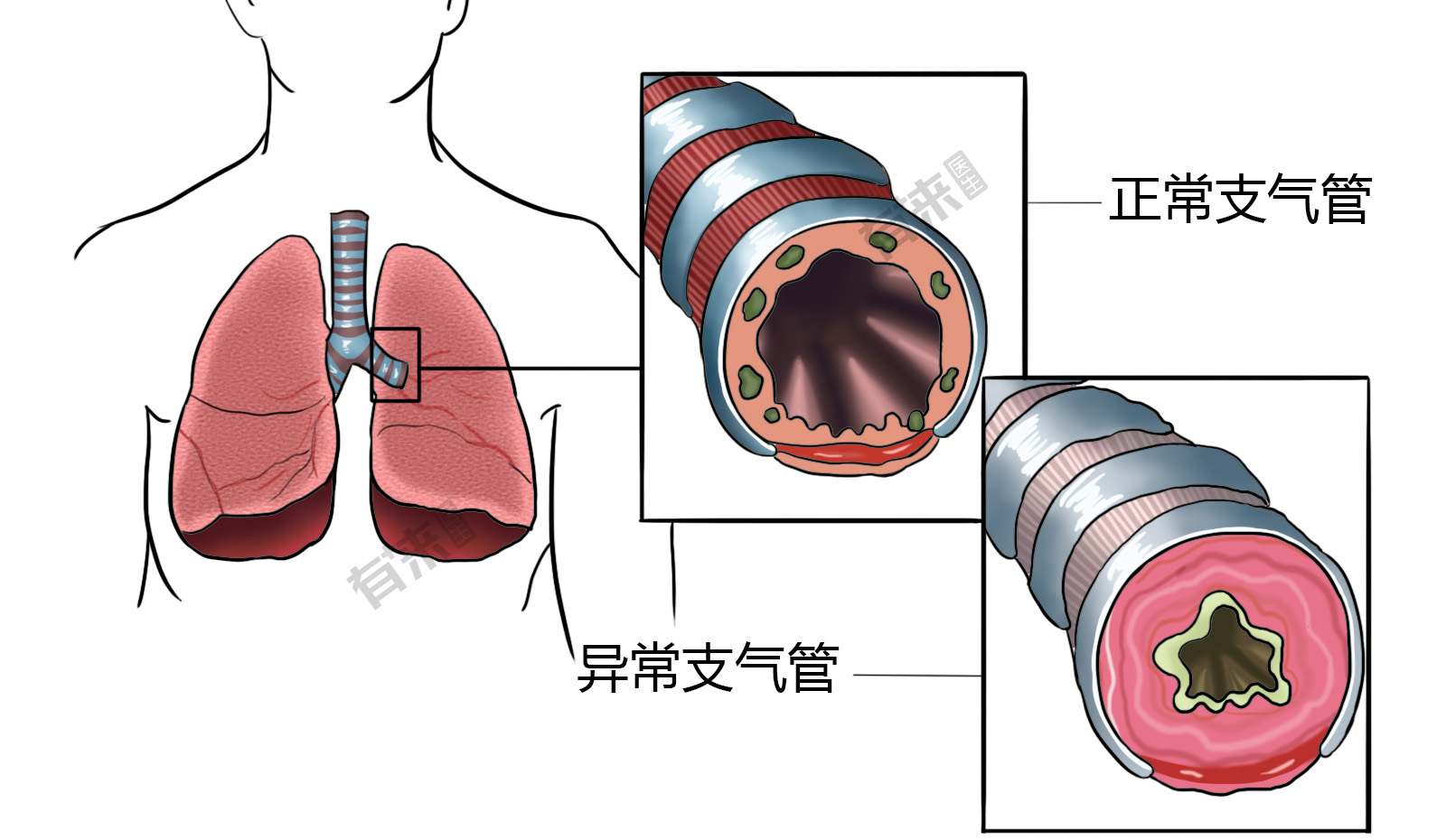 气管图片高清示意图图片