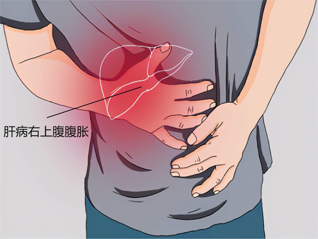 肝病右上腹腹胀图