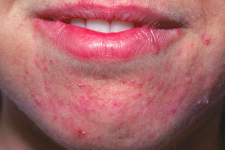 艾滋病急性感染期下巴小红疙瘩图