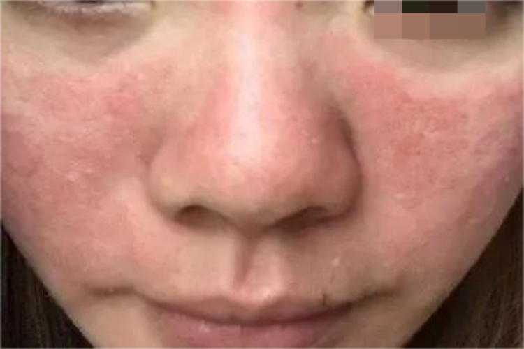 接触性皮炎脸部鼻子皮损图 接触性皮炎脸部鼻子皮损图