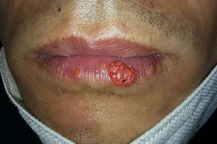 唇癌患者早期会出现疱疹状,结痂的肿块,随后可出现火山口状溃疡或菜花