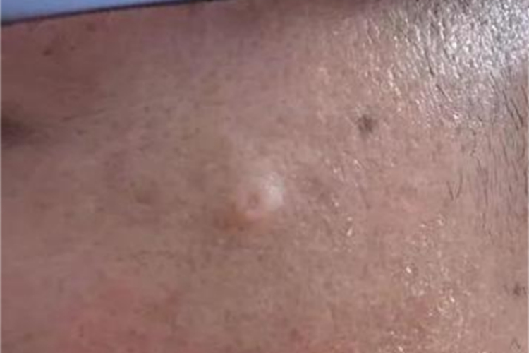 老年性皮脂腺增生圆疙瘩图 老年性皮脂腺增生圆疙瘩图