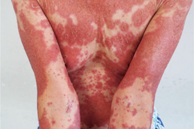 红皮病慢性期红斑图