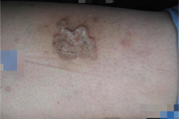 汗孔角化病小腿斑片图